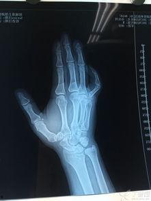 成人骨科矫正足弓视频