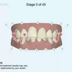 成人骨科矫正足弓视频