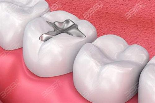 成人补牙流程图解视频,轻松了解每一步操作